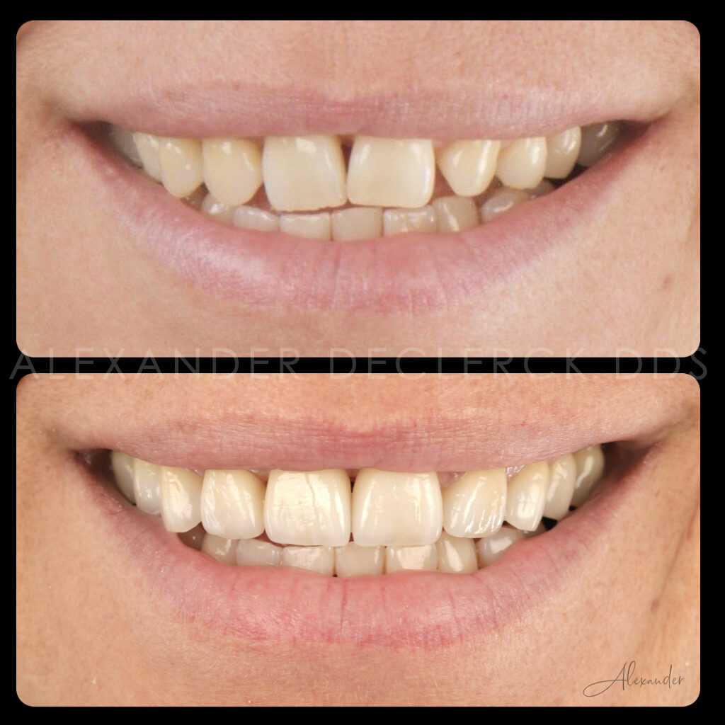 10 porselein facings ter correctie van de vorm en positie van de tanden